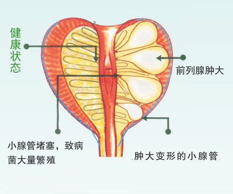 急性前列腺炎是怎么得的